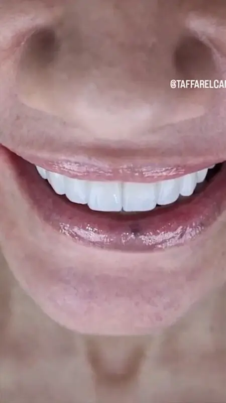 Imagem da transformação do Sorriso do Cliente 2
