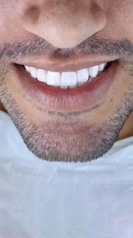 Imagem da transformação do Sorriso do Cliente 4