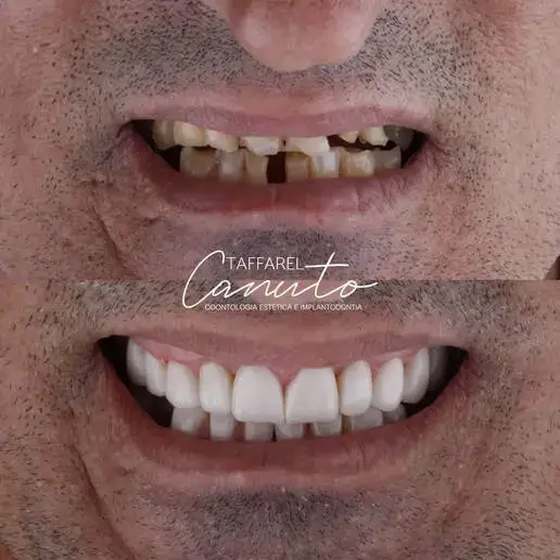Implante dentário antes e depois realizado em paciente em Morada Nova
