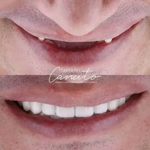 Implante dentário antes e depois realizado em paciente em Limoeiro do Norte