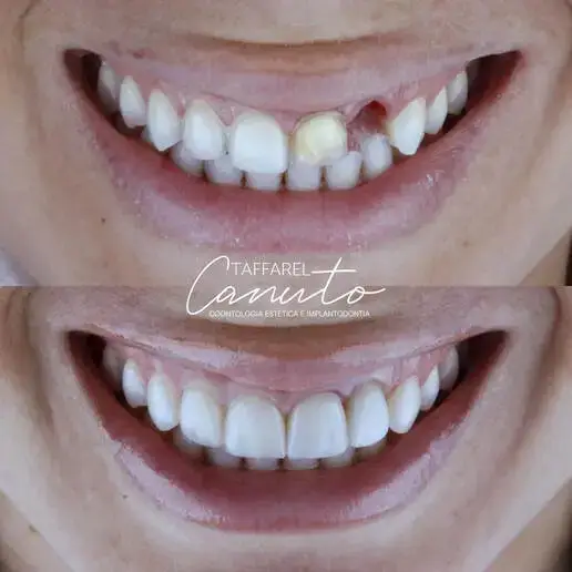 Resultado Antes e Depois do Cliente 3